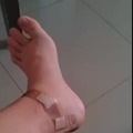 Tremenda herida en el pie