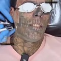 Removing face tattoo with laser